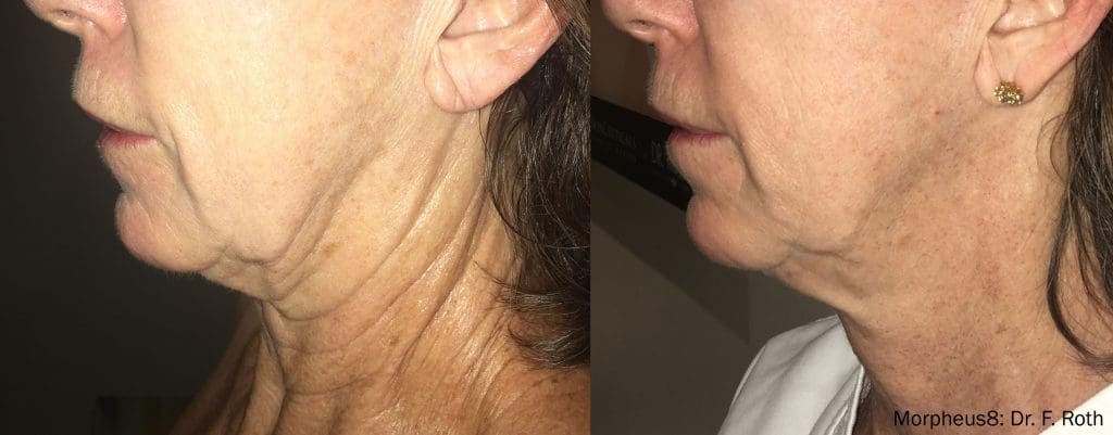 Morpheus8 Facial