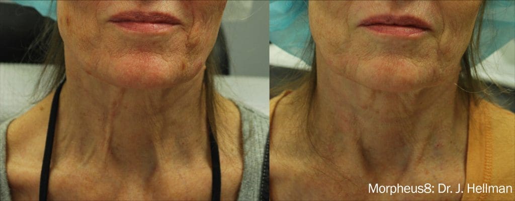 Morpheus8 Facial before after