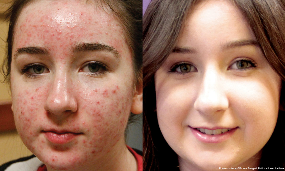 BBL Before & After
