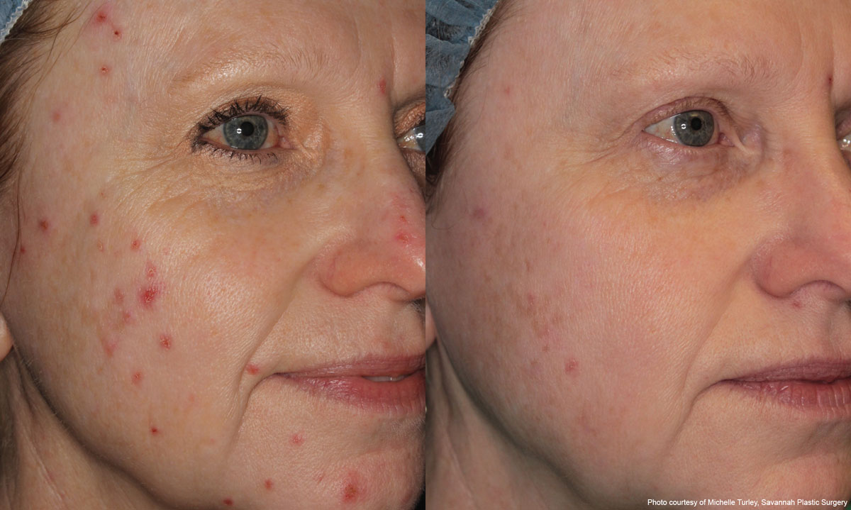 BBL Before & After