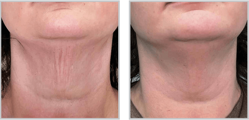 BBL Before & After
